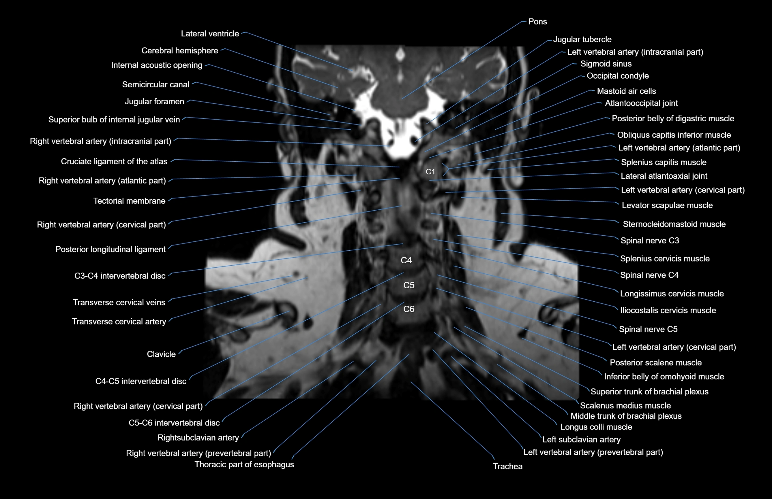 Neck coronal cross sectional MRI anatomy 3T MRI  image-img-00001-00028.webp